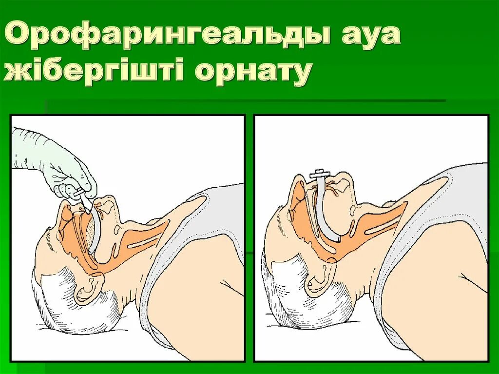 Соотношение компрессий и вдуваний новорожден. Жүрек өкпе реанимациясы. Тыныс алу жүйесінің медбикелік күтім презентация. Жүрек өкпе реанимациясы. Окпе журек реанимациясы реферат.