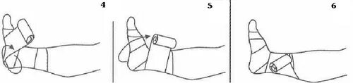 Наложение эластичного бинта на конечность. Бинтование эластичным бинтом при варикозе. Бинтование ног эластичным бинтом при варикозе. Бинтование ног эластичным бинтом перед операцией алгоритм. Наложите эластический бинт на нижнюю конечность.