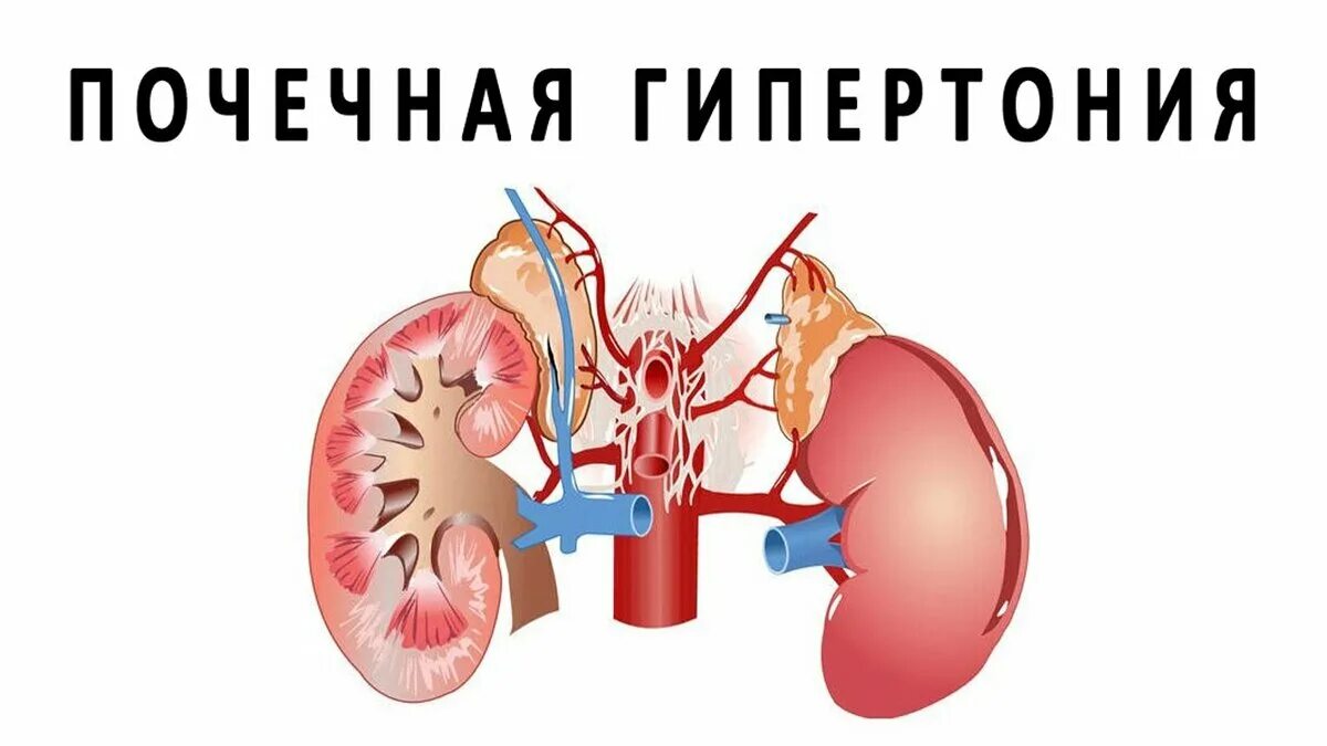 Давление при заболевании почек. Почечная гипертензия. Нефрогенной артериальной гипертензии. Почечная артериальная гипертензия.