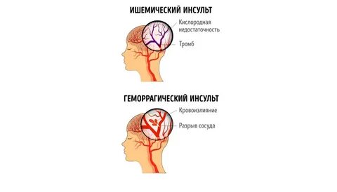 Головная боль при инсульте