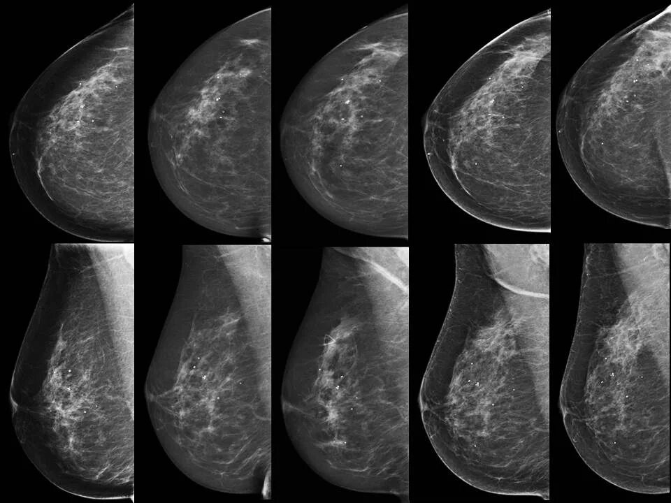 Маммография обязательно. Рентген молочных желез маммография аппарат. Мамаогра. Цифровая маммография молочных желез. Цифровая маммография снимки.