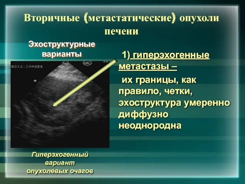 Очаговое образование в правой доле в. Гиперэхогенное образование на УЗИ. Гиперэхогенность печени. Гиперэхогенная структура.