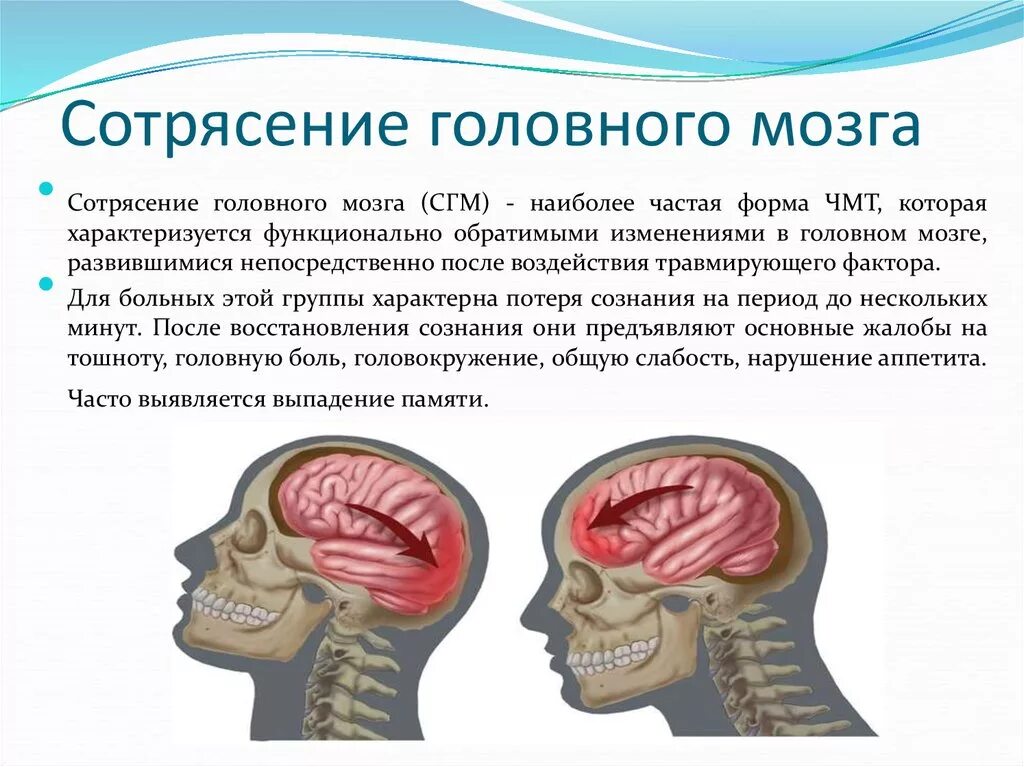 Сотрясение симптомы и лечение. Три основных признака при сотрясении головного мозга.. Симптомом сотрясения головного мозга является. Основной симптом тяжелого сотрясения головного мозга. Симптоматика сотрясения головного мозга обуславливается.