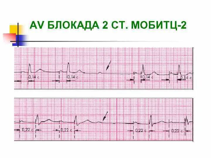 Блокады 2 степени армия. АВ блокада 2 ст. АВ блокада 2 Мобитц 2 на ЭКГ. АВ блокада 2 степени на ЭКГ. АВ блокада Мобитц 1 2 3 степени.