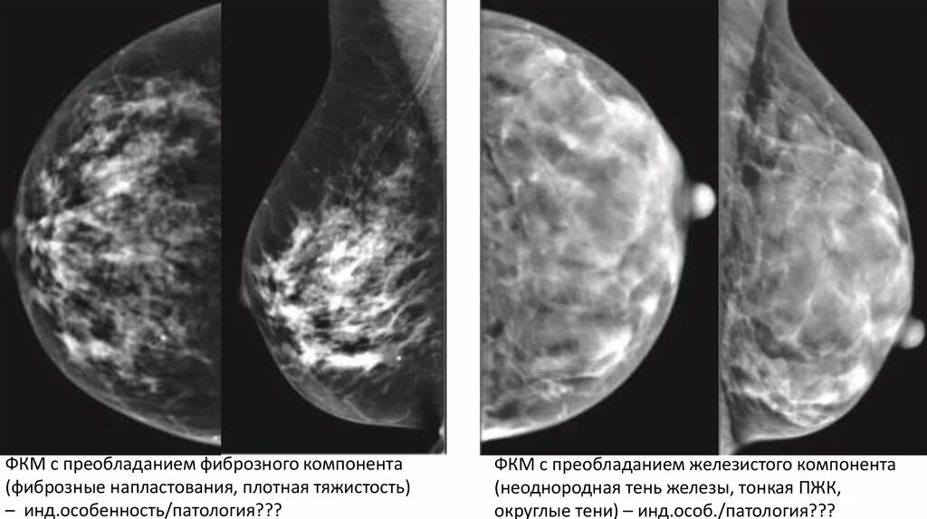 Маммография ростов на дону. Кистозная мастопатия маммография. Фиброзно кистозная мастопатия маммограмма. Фиброкистоз маммография. Фиброзно-кистозная мастопатия фотоснимки.