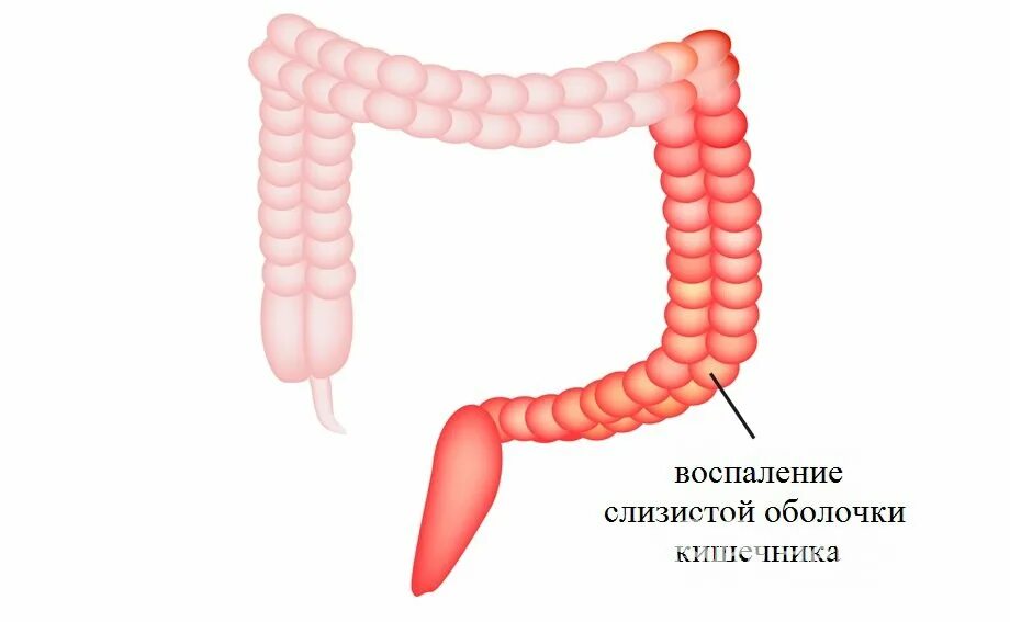 Слизистый слой кишки. Воспаление слизистой толстой кишки. Толстая кишка воспаление. Воспаление Толстого кишечника. Воспаленная слизистая кишечника.