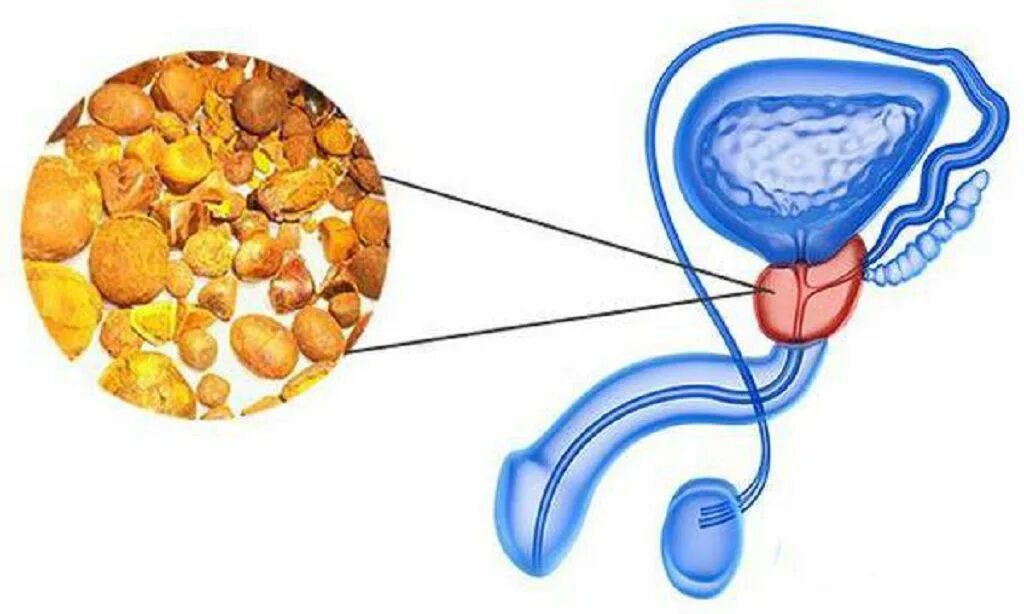 Конкременты предстательной железы. Застойный калькулезный простатит что это. Кальцинатов предстательной железы. Калькулезный простатит у мужчин.
