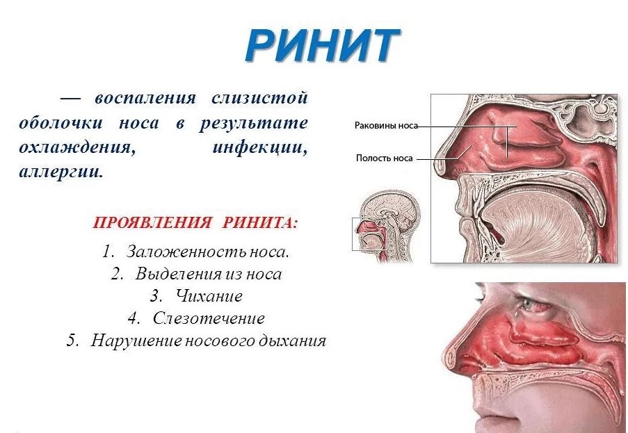 Как быстро снять отек слизистой носа. -++воспаление слизистой оболочки носа - ринит.. вазомоторный аллергический ринит симптомы. слизистая оболочка носа при аллергическом рините. вазомоторный ринит гортань.