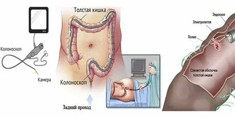 Колоноскопия при беременности