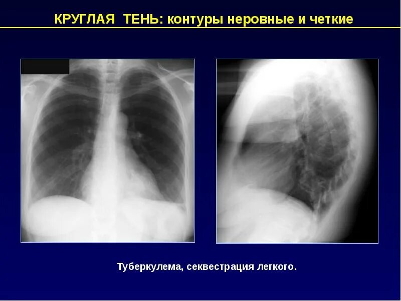 С неровным четким контуром. Доброкачественное узловое образование щитовидной железы. С неровным четким контуром. С неровным четким контуром. Гипоэхогенные узлы на узи щитовидной железы.