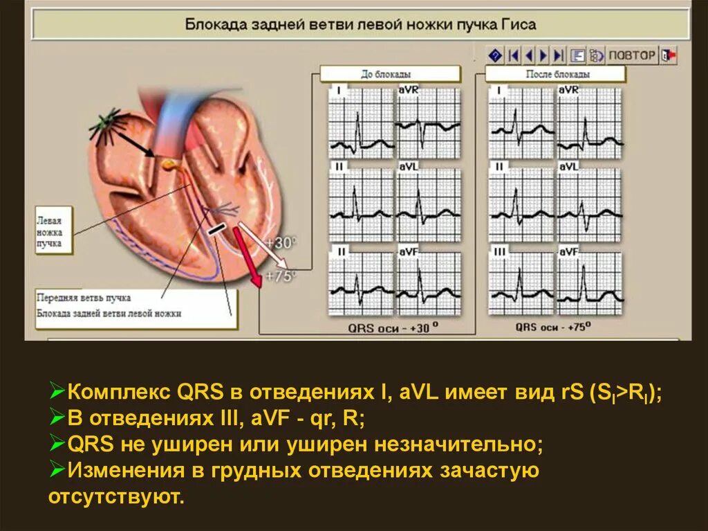 Блокада задней ветви левой ножки пучка Гиса на ЭКГ. ЭКГ при блокаде левой задней ветви пучка Гиса. Блокада передней ветви левой ножки пучка Гиса на ЭКГ. ЭКГ при блокаде передней ветви левой ножки пучка Гиса. Блокада левого и правого пучка гиса