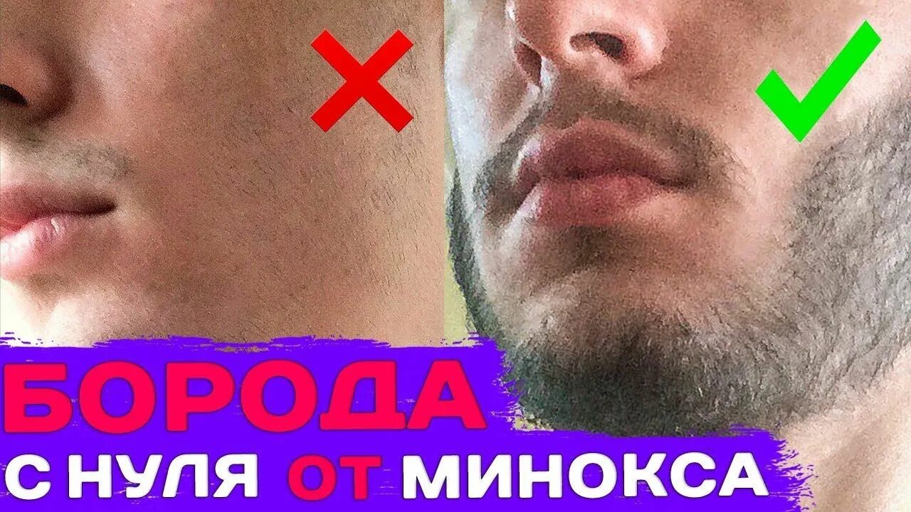 Как правильно отрастить бороду с нуля. Миха борода миноксидил. борода с нуля миноксидил. миноксидил от михи бороды. отрастить бороду с нуля.