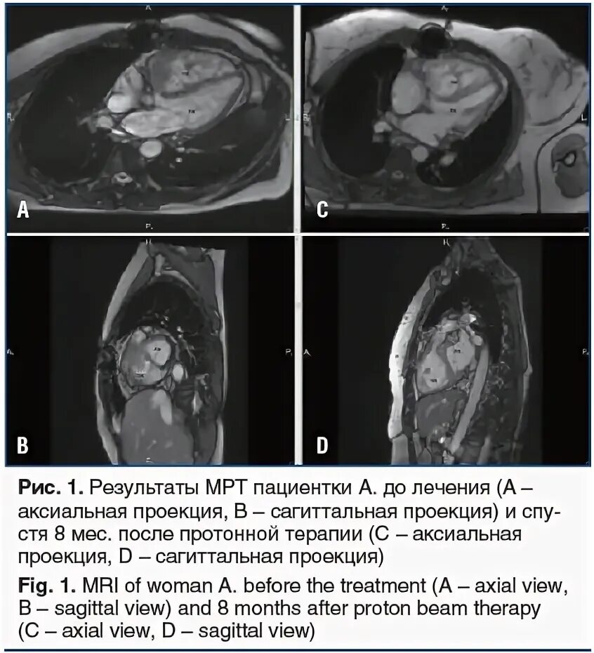 Мрт результаты сразу. Результаты мрт. Сагиттальная проекция мрт. Мрт после лучевой терапии. Протонная мрт.