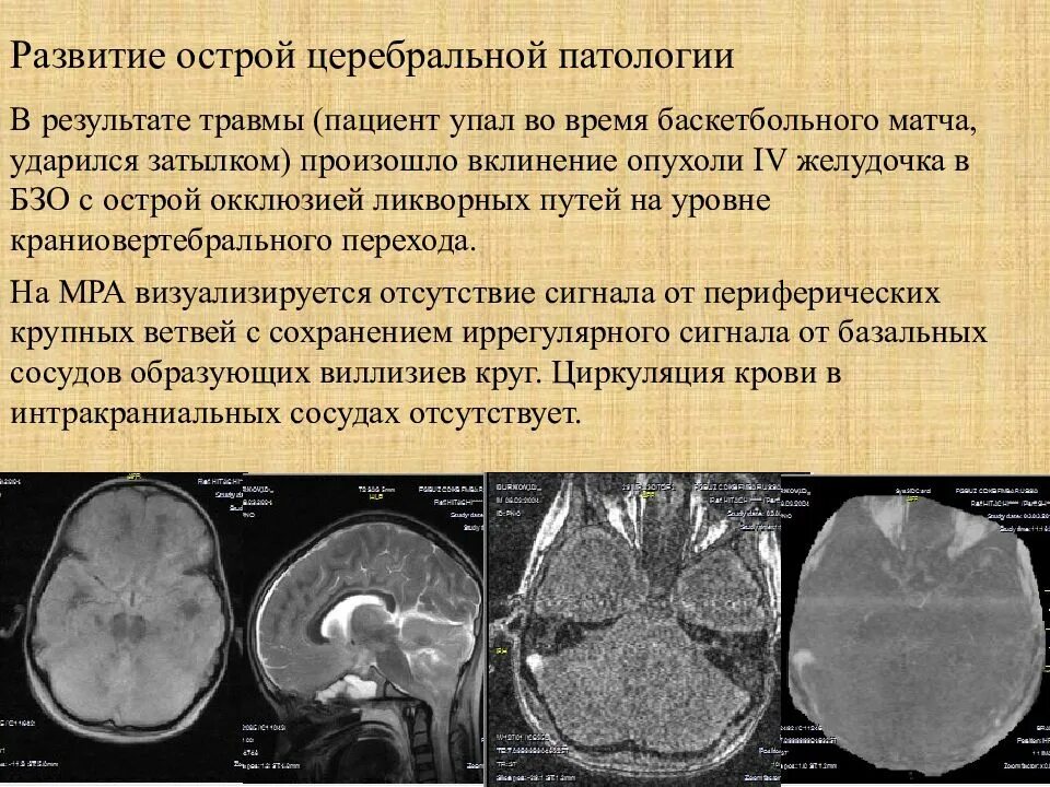 Ишемия мозга дают ли инвалидность. Объемные образования головного и спинного мозга. объемное образование головного мозга у ребенка. новообразование в головном мозге.