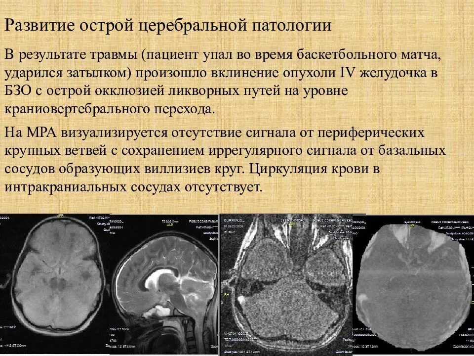 Опухоли желудочков. Объемное образование головного мозга. Новообразование в головном мозге. Кистозные опухоли головного мозга. Объемное образование головного мозга у ребенка.