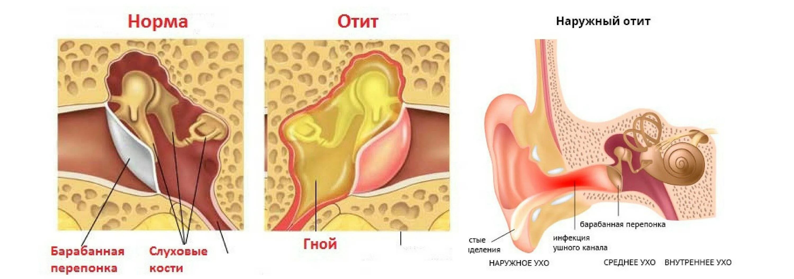 Почему заболели уши. Туботимпанальный Гнойный отит. Наружный отит барабанная перепонка. Воспаление наружного слухового прохода (отит). Отит вид барабанной перепонки.