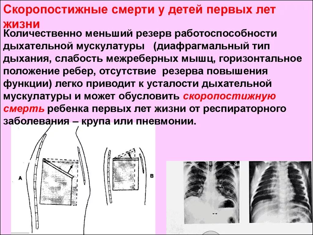 Афо органов дыхания у детей. Анатомо физиологические особенности легкие у детей. Особенности легких у детей. Диафрагмальный Тип дыхания у детей.