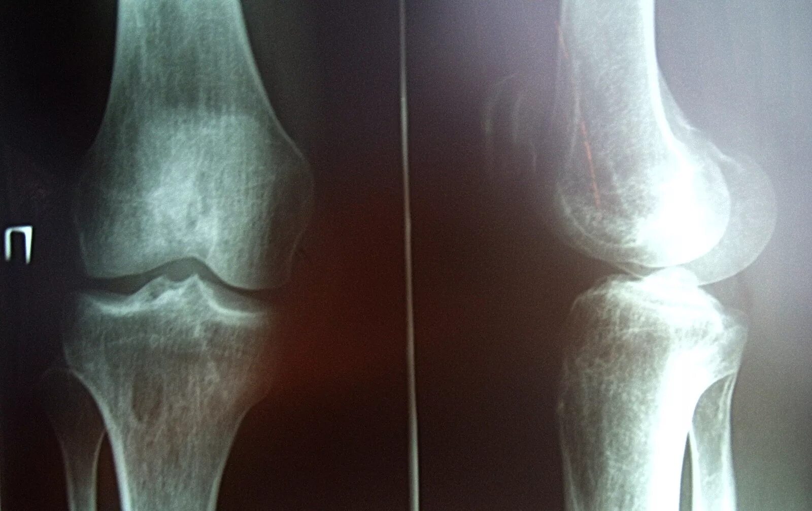 Перелом мыщелка коленного сустава. Коленный мыщелок перелом. Вколоченный перелом коленного сустава. Мыщелки коленного сустава перелом. Перелом надколенника операции