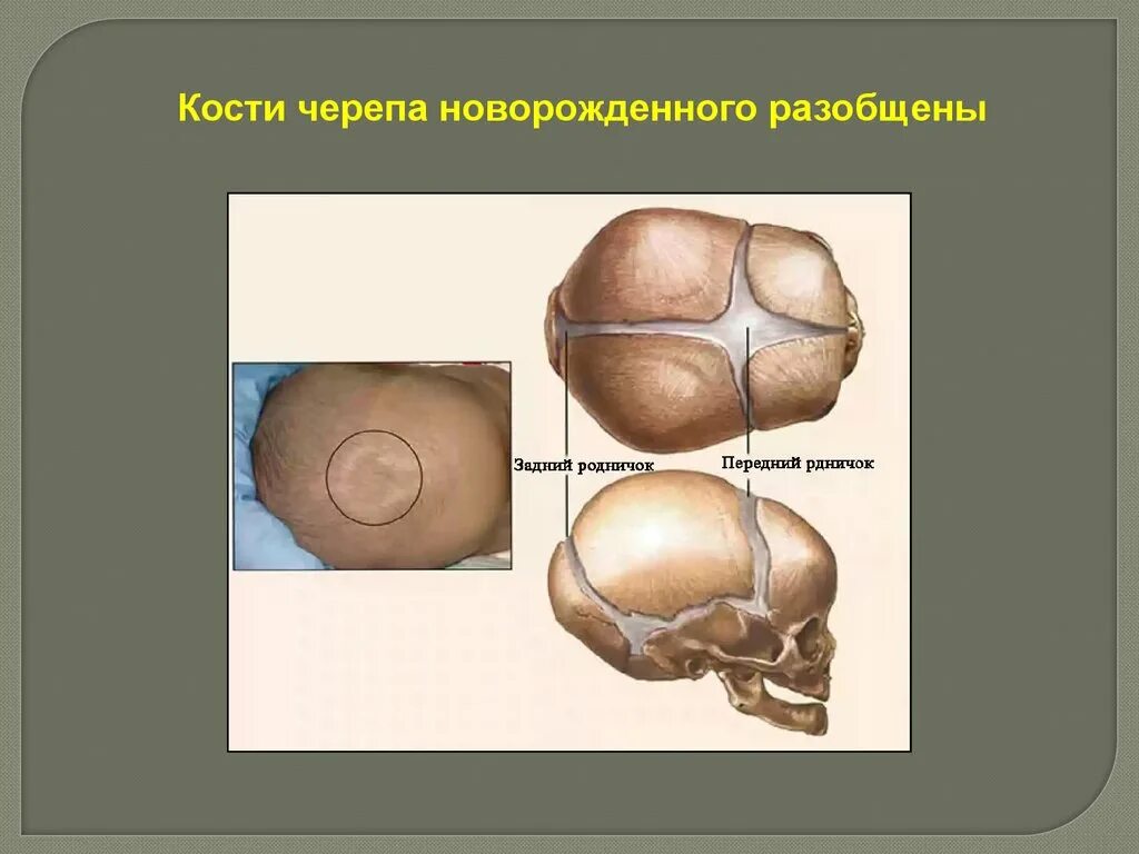 Кости черепа новорожденного. Череп новорожденного анатомия. Соединения костей черепа новорожденного.