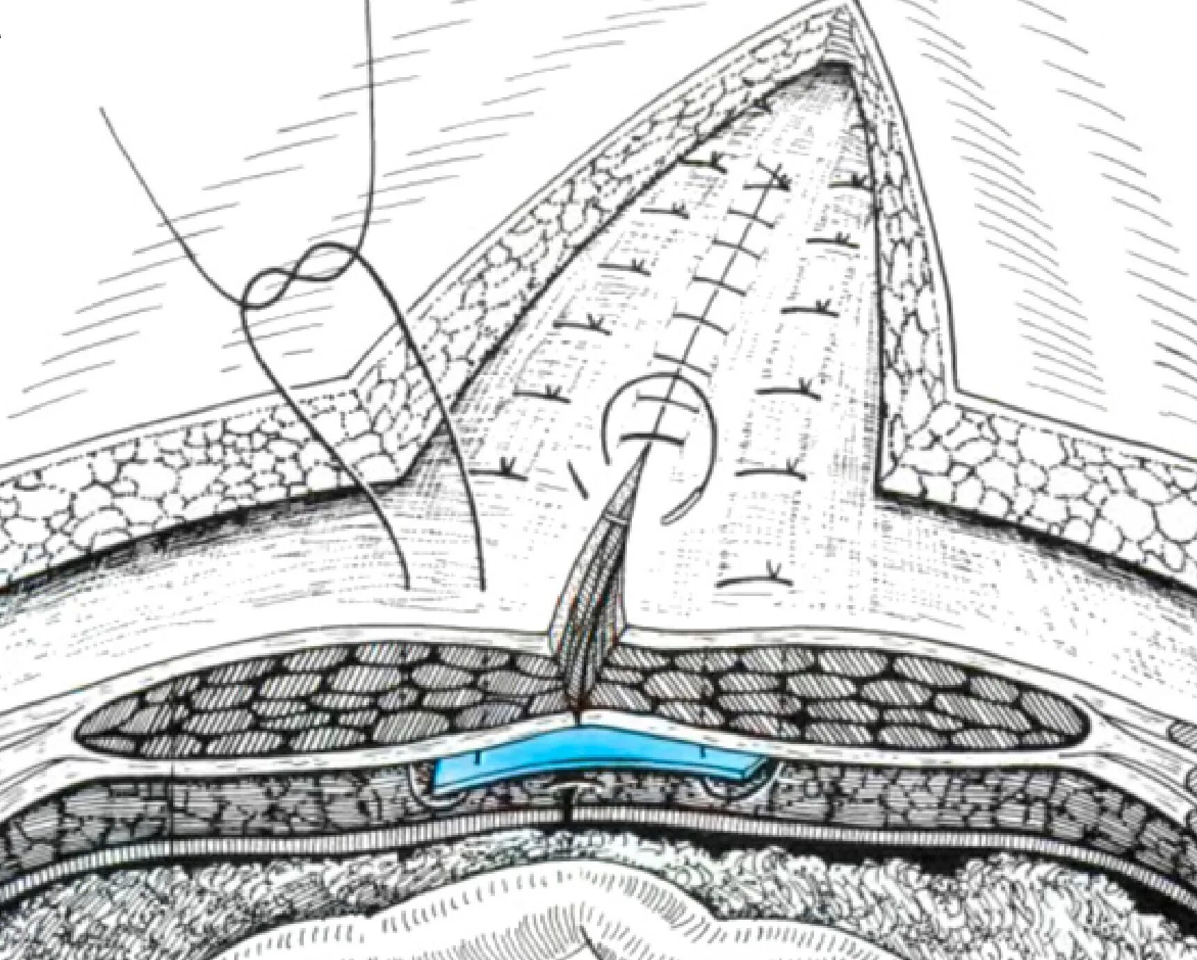 пластика грыжи сеткой. паховая грыжа операция по лихтенштейну. герниотомия пластика по лихтенштейну. операция лихтенштейна при паховой грыже схема. грыжесечение паховой грыжи по лихтенштейну.