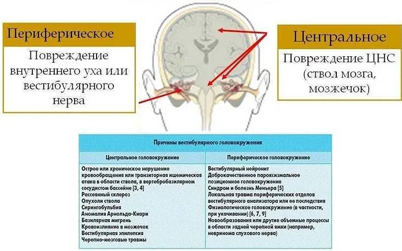 Головокружение при вставании при нормальном давлении. Периферическое вестибулярное головокружение. заболевания вестибулярного аппарата. центральный вестибулярный синдром. терапия вестибулярных головокружений.