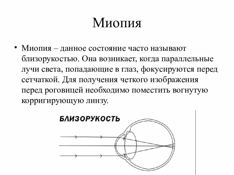 Лучи света фокусируются перед сетчаткой. При миопии лучи фокусируются. При близорукости лучи света фокусируются. При близорукости лучи света фокусируются за сетчаткой. Лучи света фокусируются за сетчаткой