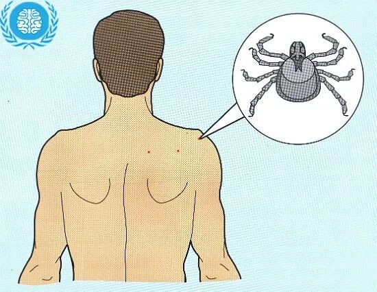 Последствия клещевого энцефалита у человека фото Как происходит заражение человека энцефалитом