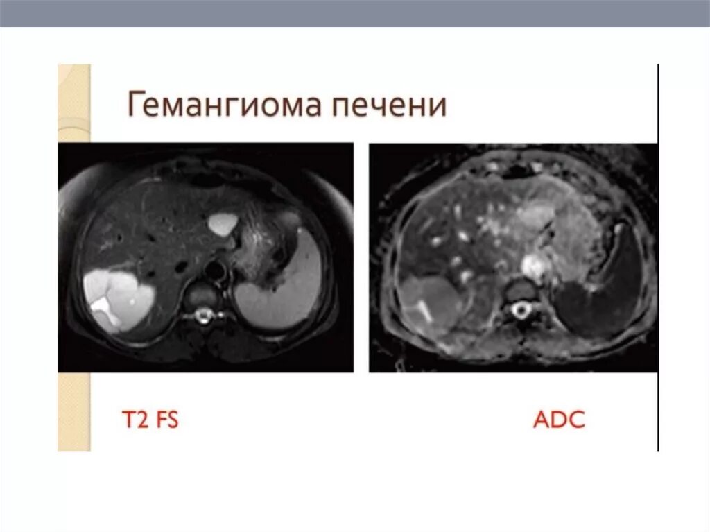 Жидкостные образования печени кт. Сосудистые образования печени кт. Образования печени кт