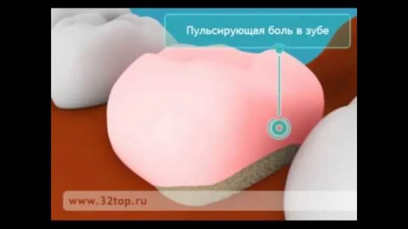 Зуб пульсирует и болит. Ноющая пульсирующая боль в зубе.