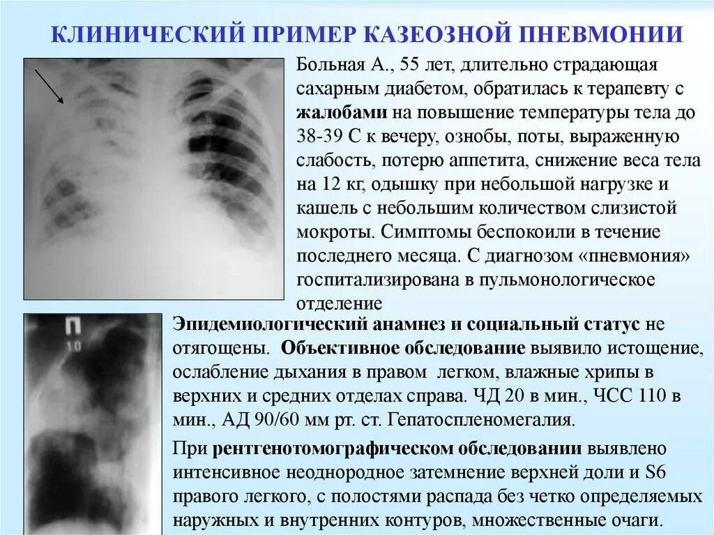 Описание снимка. Казеозная пневмония рентген синдром. Казеозная пневмония рентген. Казеозная пневмония на рентгенограмме. Двусторонняя казеозная пневмония рентген.