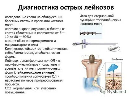 Острый лейкоз обследование