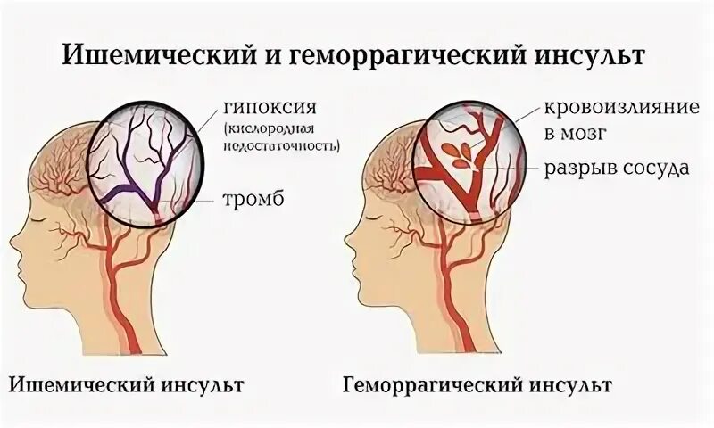 Инсульт правая сторона тела. Инсульт левого полушария. Ишемический инсульт правого полушария. Ишемический инсульт правого полушария головного мозга. Ишемический инсульт правого полушария реабилитация.