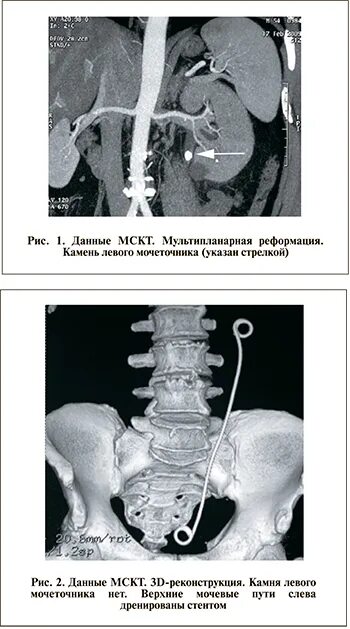 Конкремент устья мочеточника кт. Конкремент н 3 левого мочеточника. Кт почек камень мочеточника. Стент в мочеточнике рентген. Н 3 кт