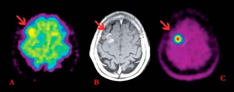 Позитронно-эмиссионная томография мозга. ПЭТ кт опухоли головного мозга. Позитронно-эмиссионная томография опухоли. Позитронная эмиссионная томография (ПЭТ) головного мозга..