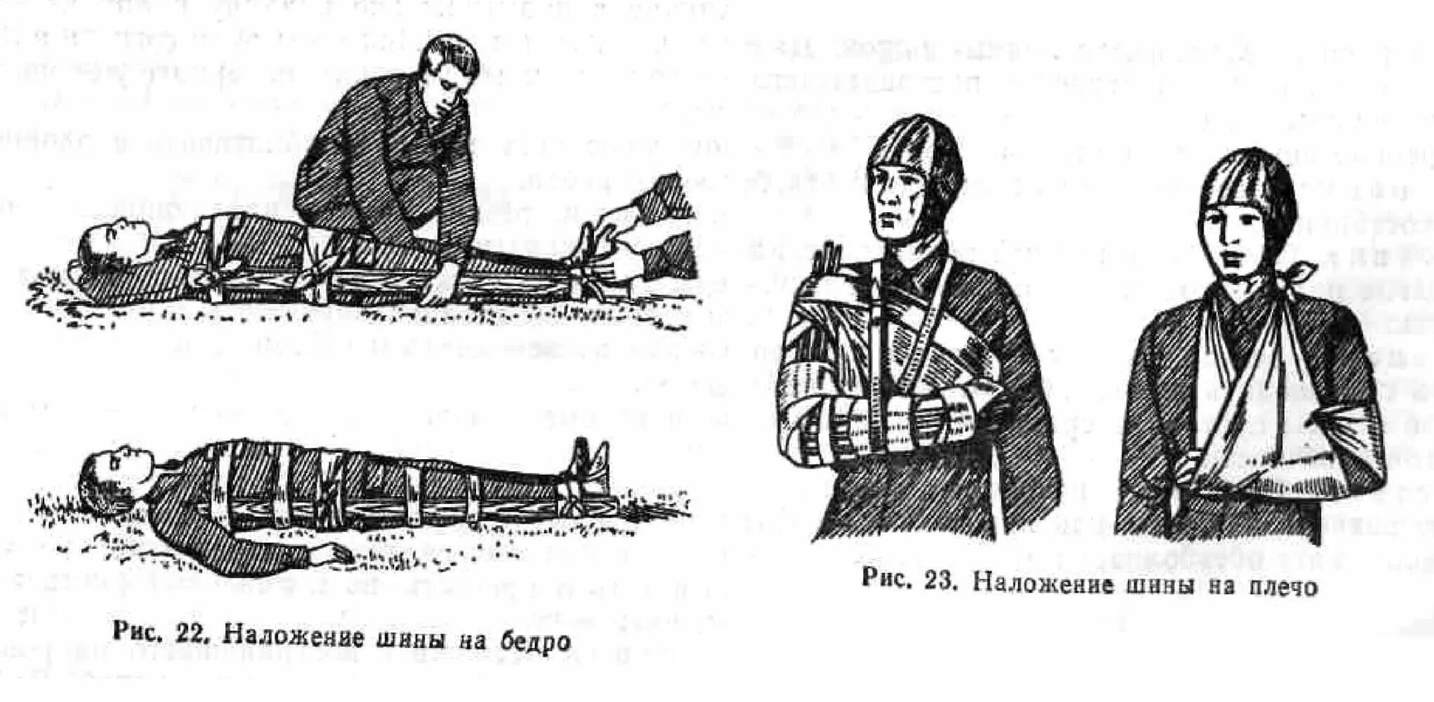 Техника наложения шин при переломах. При наложении шины.