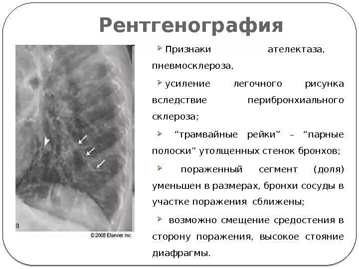 Сколько живут с пневмосклерозом