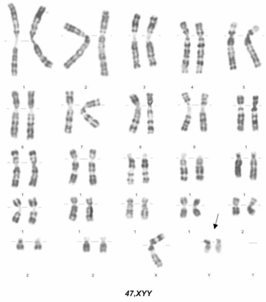 Появление дополнительной хромосомы. XYY кариограмма. Кариотип 47 хуу синдром. Синдром Клайнфельтера кариотип.
