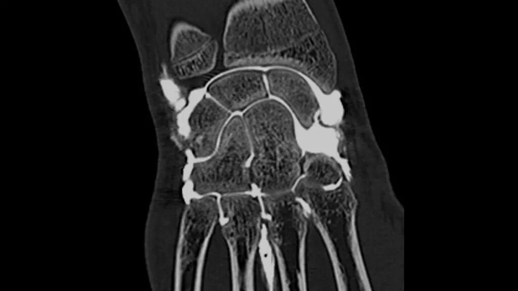 Артрит кт. Ревматоидный артрит мрт кисти. Мрт лучезапястного сустава. Синовит лучезапястного сустава мрт. Ревматоидный артрит мрт лучезапястный.