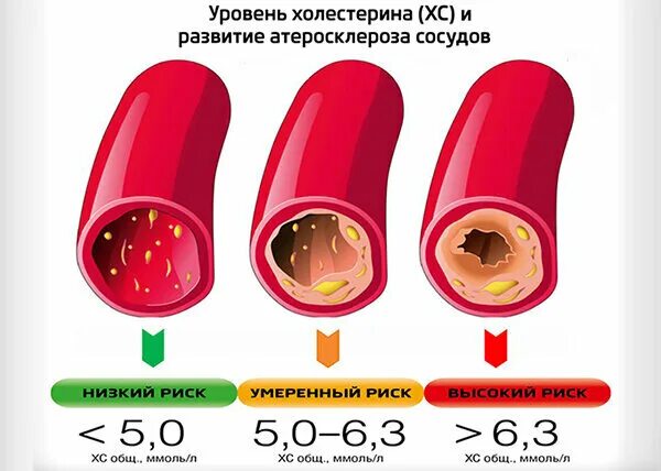 Повышенный холестерин в крови таблица Как снизить уровень триглицеридов в крови