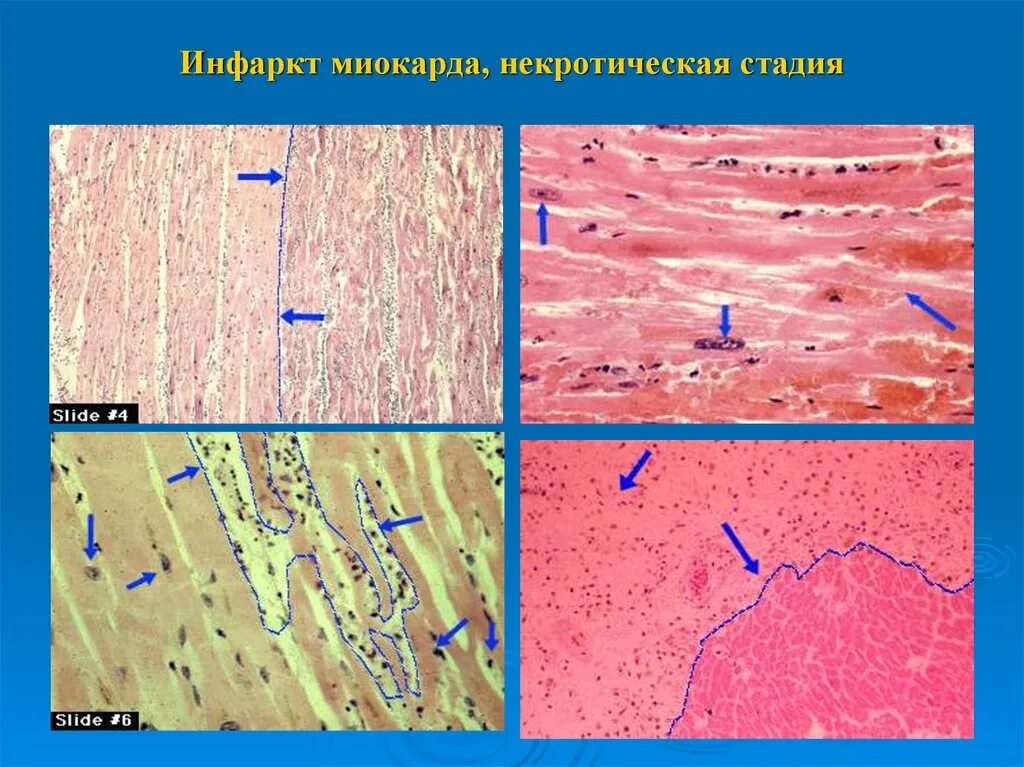 Зона ишемии. Острый инфаркт миокарда микропрепарат. Острый инфаркт миокарда гистология. Препарат острый инфаркт миокарда гистология. Ишемический инфаркт миокарда макропрепарат.