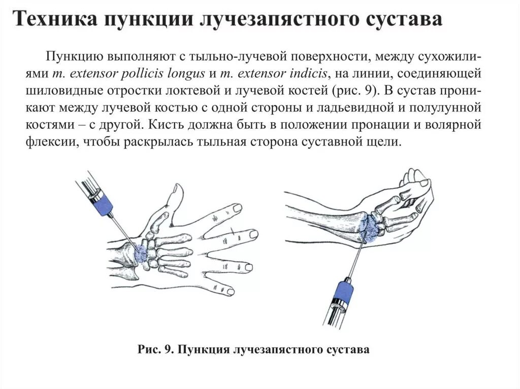 Пункция сустава техника выполнения. Точка пункции лучезапястного сустава. Пункция первого запястно-пястного сустава. Техника пункции плечевого, локтевого, лучезапястного суставов.. Пункция лучезапястного сустава направление иглы.