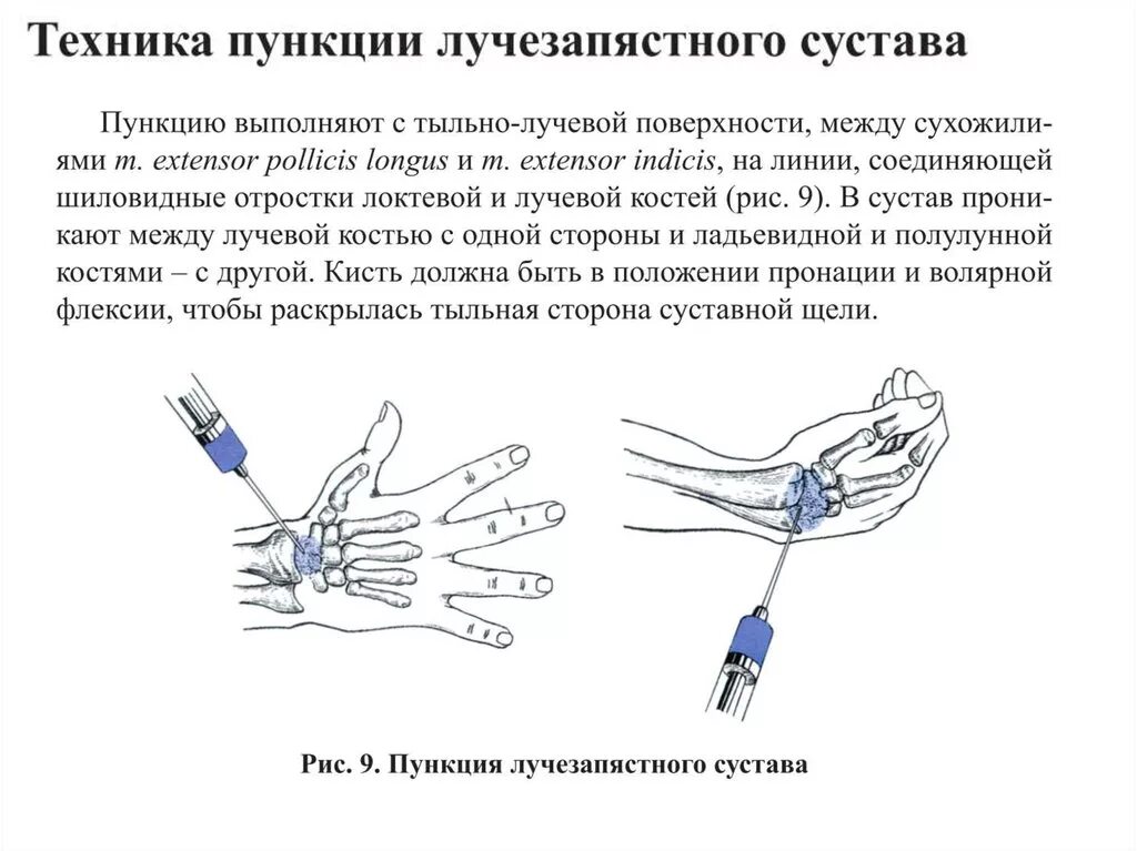 Точки для пункции лучезапястного сустава. Пункция запястного сустава техника выполнения. Пункция лучезапястного сустава техника. Схема пункции Луче зарястного сустпва. Уколов уколы в кисть