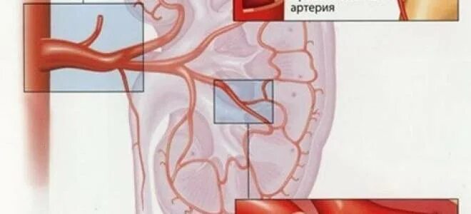 Коленообразная почечная артерия. Тромбоз почечной артерии. Атеросклероз почечных артерий Патан. Атеросклероз артерий почек почечная форма. Тромбоз почечной вены