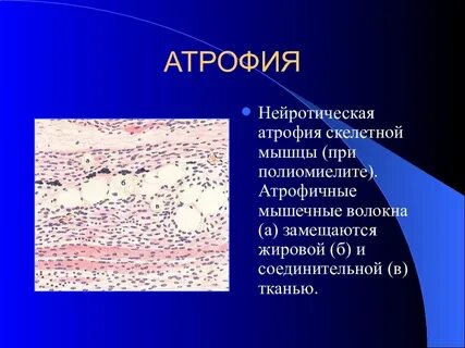 Развитие мышечных атрофий