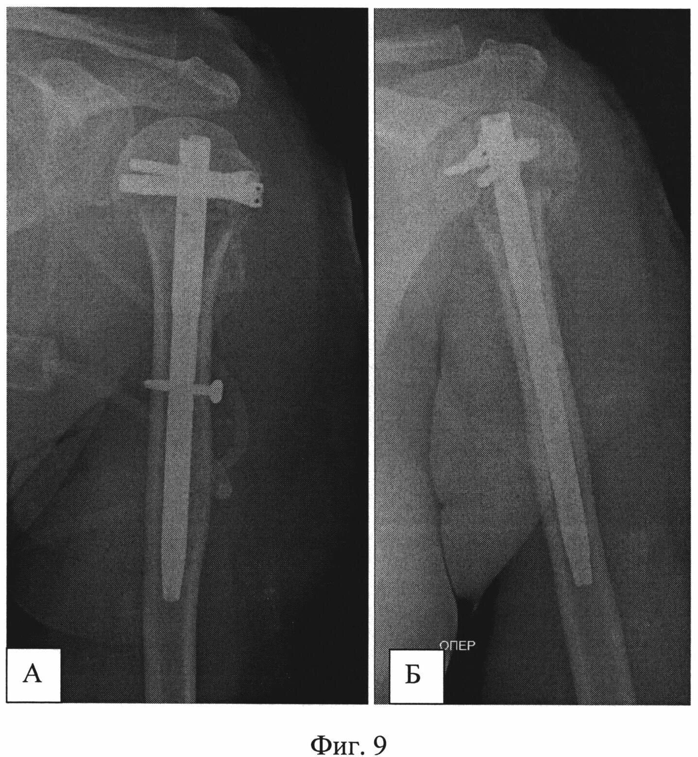 Интрамедуллярный (внутрикостный) остеосинтез. Внутрикостный остеосинтез плечевой. Перелом плеча остеосинтез. Интрамедуллярный штифт плечевой кости рентген. Перелом плеча пластина