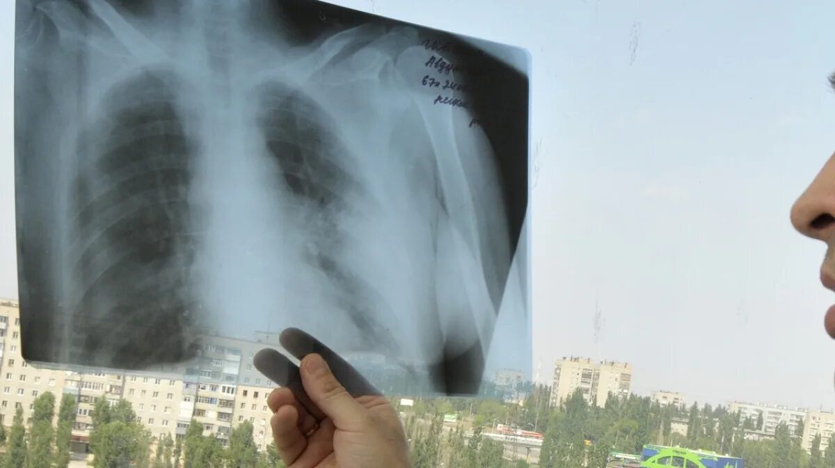 Рентген самый новый. Рентгеновский снимок на термобумаге. Туберкулез в спб