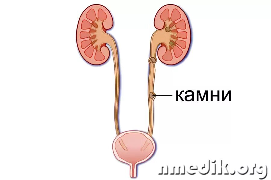 Как выглядит мочеточник. Мочекаменная болезнь мочеточника. Камни почек и мочеточников. Симптомы. Почки мочеточники мочевой камень. Камень н/3 левого мочеточника.