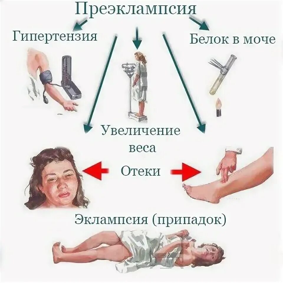 Судороги в родах