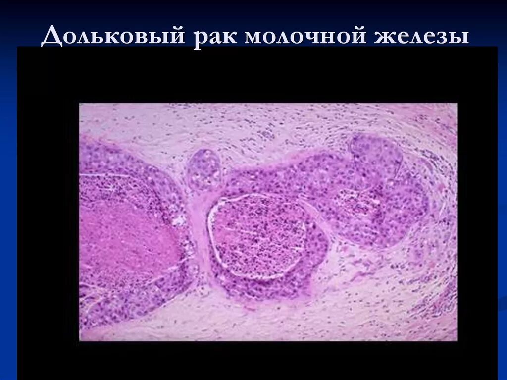 Инвазивная протоковая карцинома гистология. Внутрипротоковая папиллома гистология. Карцинома щитовидной железы гистология. Дольковая карцинома молочной железы гистология. Протоковая аденокарцинома классификация.