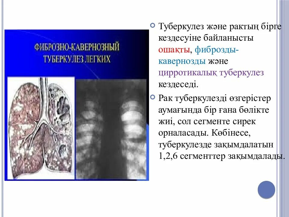 Появление туберкулеза. Презентация на тему туберкулез легких. Сообщение по теме туберкулез легких.